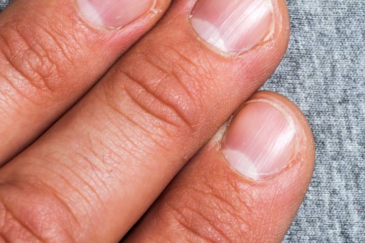Macchie e striature sulle unghie: le possibili cause