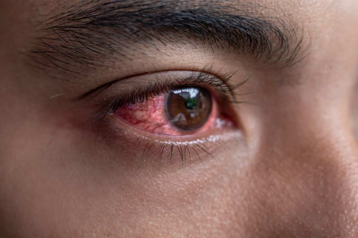 gli occhi rossi sono sintomo di una malattia grave